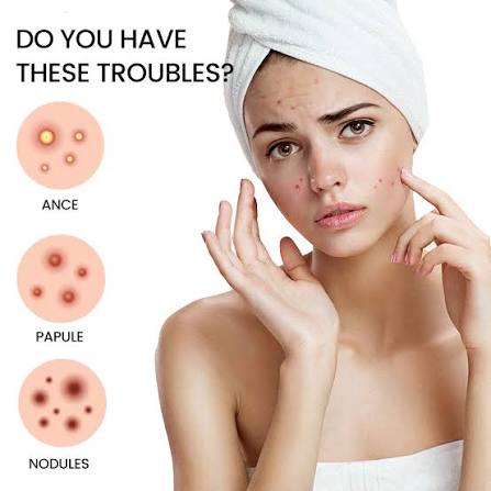 Pimple Remover Patches – 200 Patches | Fast & Natural Acne Care